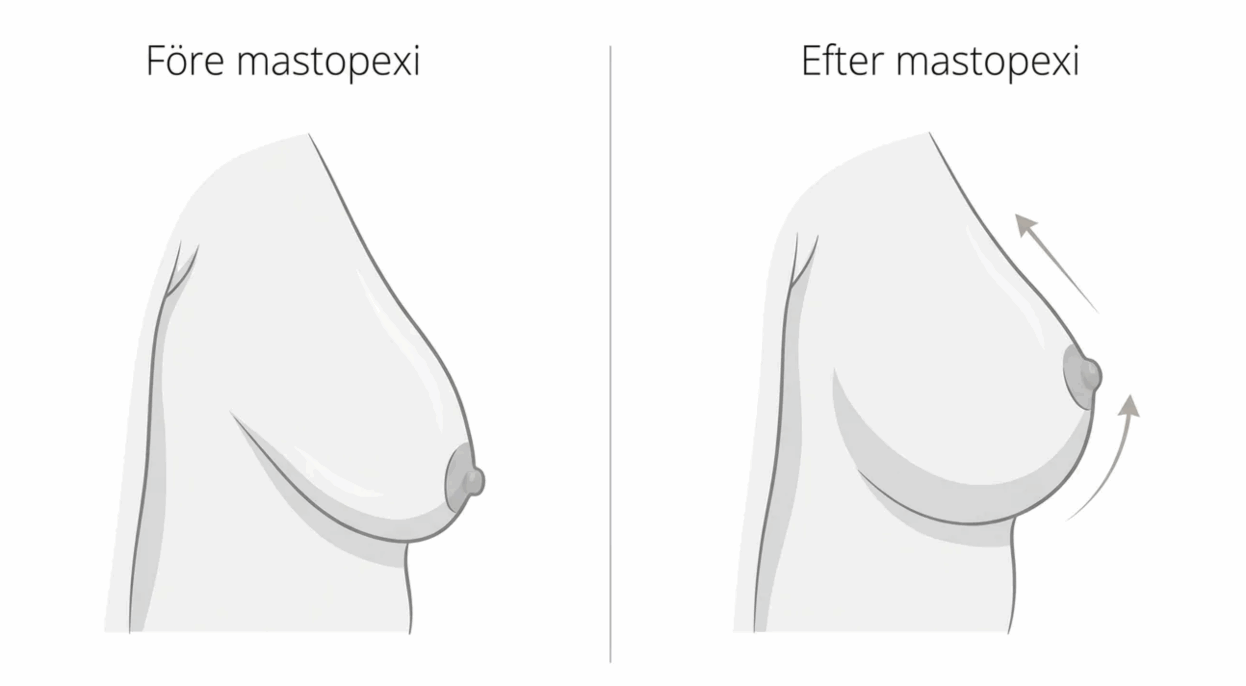 Schematisk illustration som visar bröstets position före och efter bröstlyft
Beskrivning: Medicinsk principskiss som förklarar hur bröstets form och position förändras efter mastopexi.