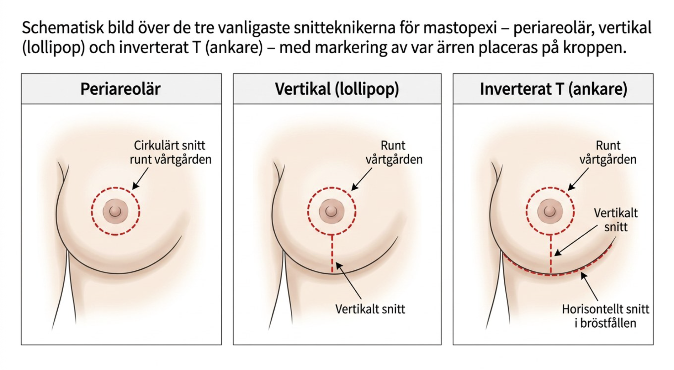 Schematisk bild av tre vanliga snitttekniker vid bröstlyft: periareolär, vertikal och inverterat T
Beskrivning: Medicinsk illustration som visar hur ärren placeras vid olika tekniker för mastopexi.